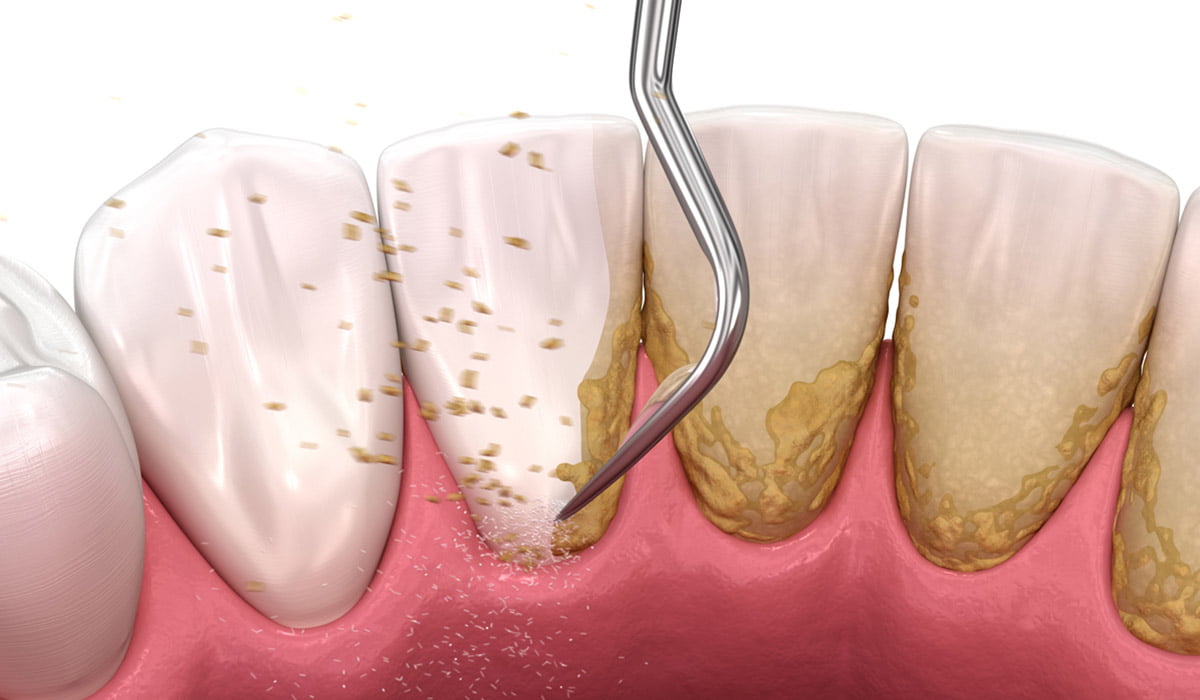 Confused Between Teeth Cleaning and Teeth Whitening? Here’s What You Need to Know