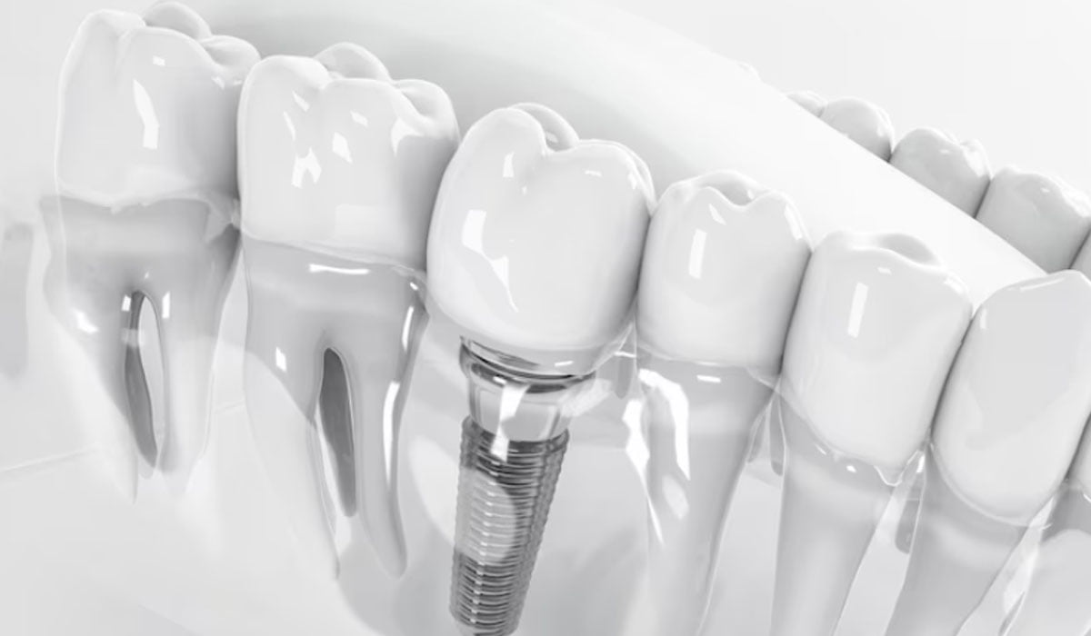 The Revolutionary Solution : Dental Implants