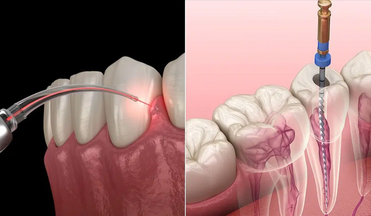 Difference Between Laser and Traditional Root Canal Treatment