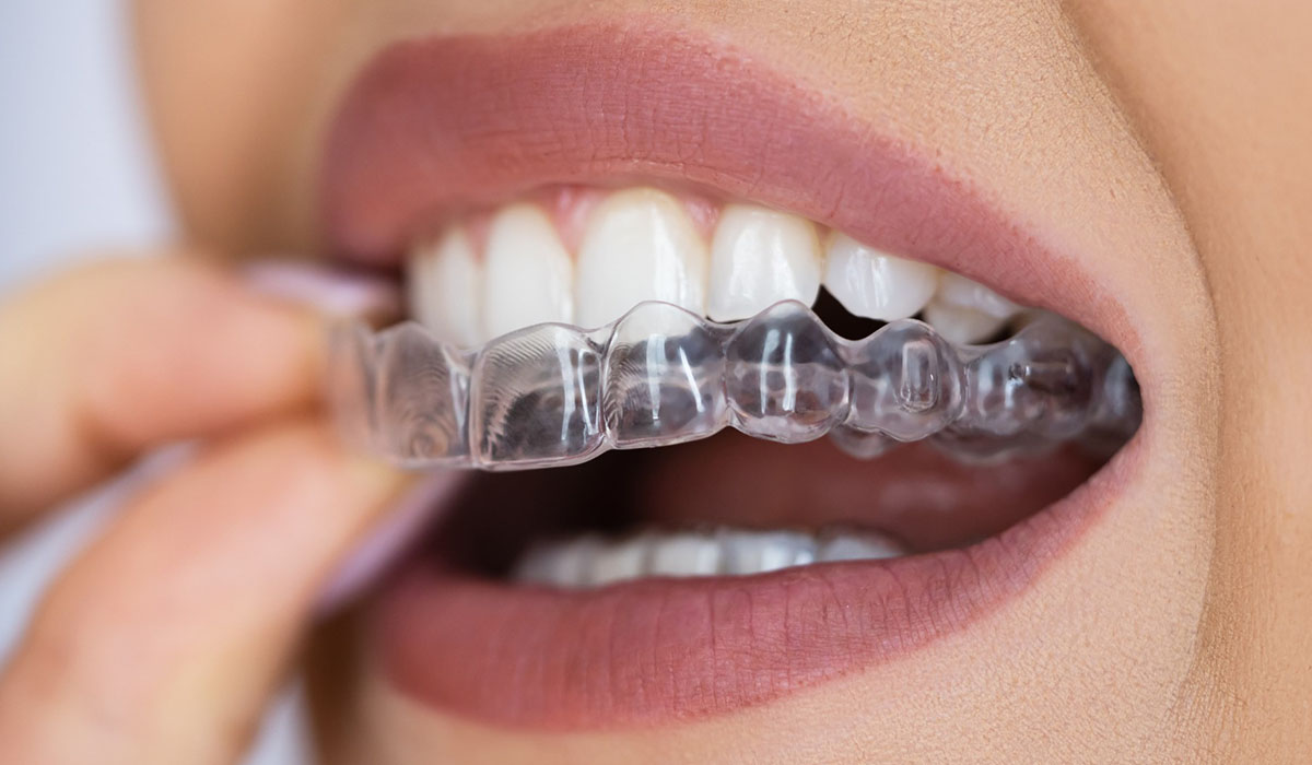 Achieve a Perfect Smile with Invisible Braces in Gandhinagar