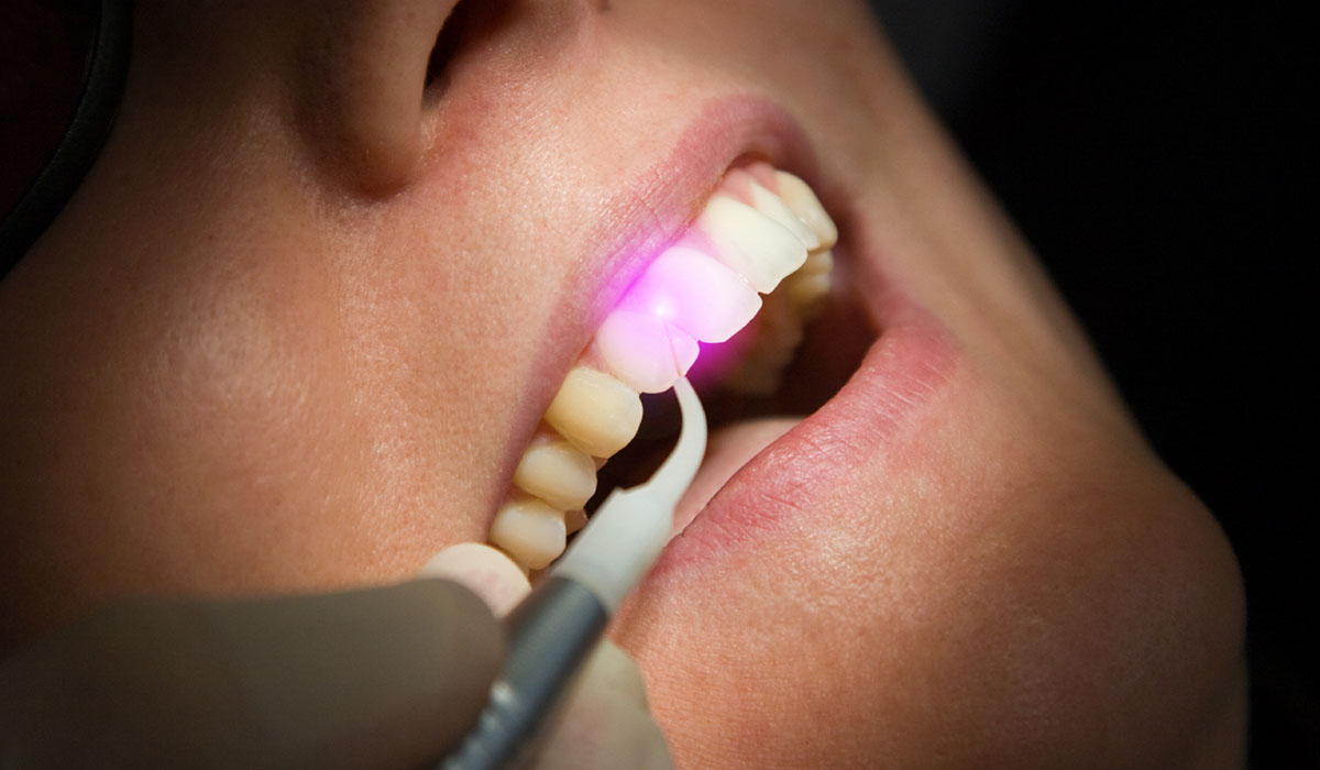 Painless Laser Gum Treatment Gandhinagar: A Gentle Approach to Oral Health