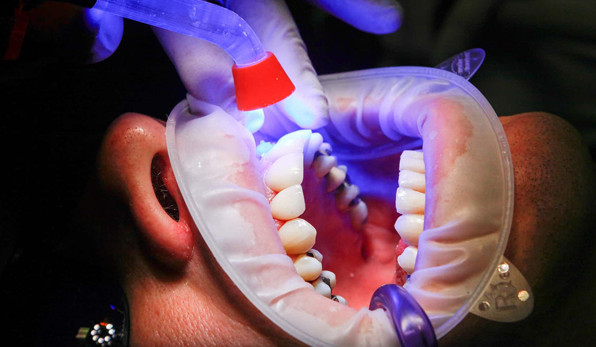 Painless Laser Treatment Gandhinagar: A Modern Approach to Dental Care